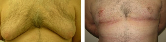 breast reduction surgery result